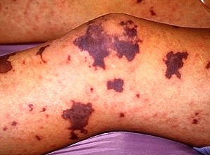 Meningococcal rash