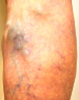 varicose veins