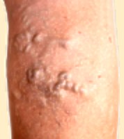 varicose veins